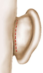 Incision de l'oreille